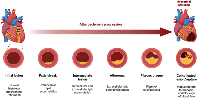 Reversing Plaque Buildup in Your Arteries: Is It Possible?